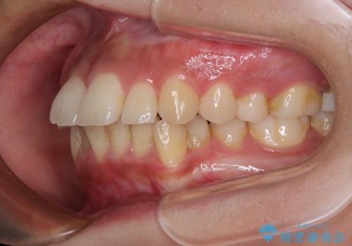 【モニター】唇が閉じにくい ワイヤー装置での抜歯矯正の治療前