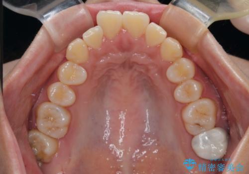 【モニター】唇が閉じにくい ワイヤー装置での抜歯矯正の治療前