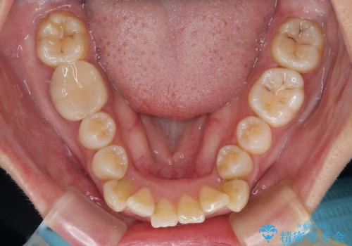 【モニター】唇が閉じにくい　ワイヤー装置での抜歯矯正の治療前