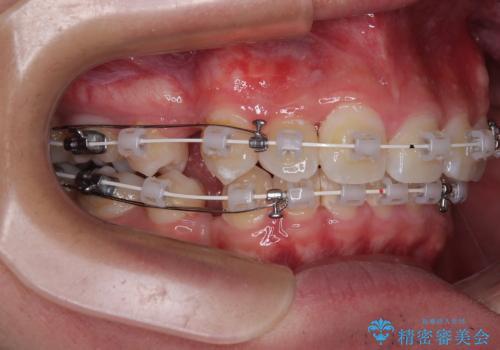 抜歯矯正で叢生と正中のずれを改善|審美装置による矯正症例の治療中