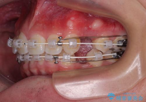抜歯矯正で叢生と正中のずれを改善|審美装置による矯正症例の治療中