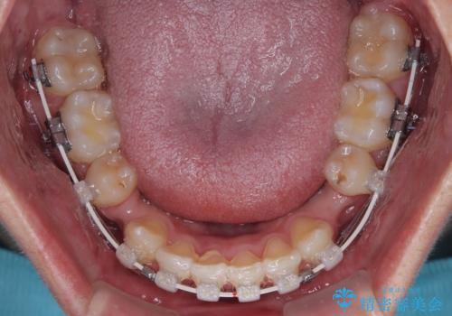 抜歯矯正で叢生と正中のずれを改善|審美装置による矯正症例の治療中