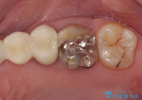 奥歯がしみる　オールセラミッククラウンによる奥歯のむし歯治療