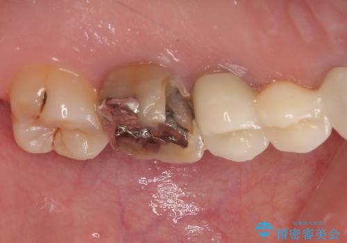 奥歯がしみる オールセラミッククラウンによる奥歯のむし歯治療の治療前
