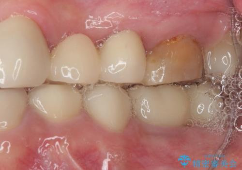 奥歯がしみる　オールセラミッククラウンによる奥歯のむし歯治療の治療前