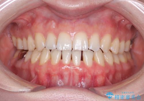 すきっ歯・切端咬合・空隙歯列|インビザラインで11ヵ月で治療完了の治療中