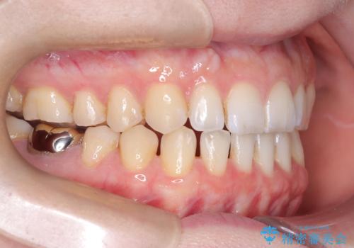 すきっ歯・切端咬合・空隙歯列|インビザラインで11ヵ月で治療完了の治療中