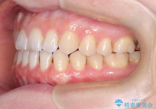 すきっ歯・切端咬合・空隙歯列|インビザラインで11ヵ月で治療完了の治療中