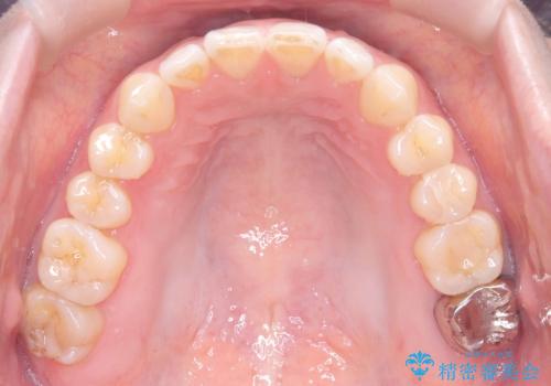 すきっ歯・切端咬合・空隙歯列|インビザラインで11ヵ月で治療完了の治療中