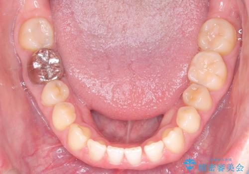 すきっ歯・切端咬合・空隙歯列|インビザラインで11ヵ月で治療完了の治療中