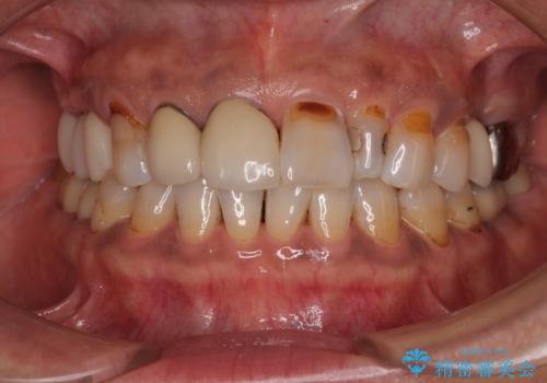 しみる前歯のセラミック治療　周辺も同時に治療して調和の取れた前歯にの治療前
