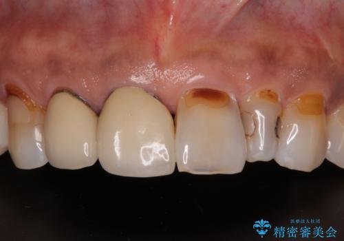 しみる前歯のセラミック治療　周辺も同時に治療して調和の取れた前歯に