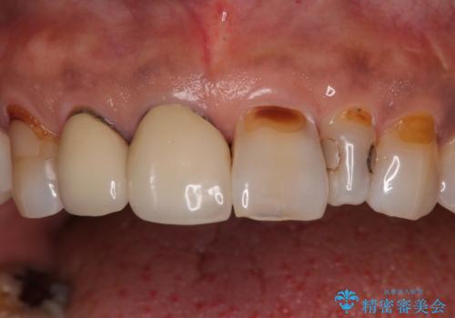 しみる前歯のセラミック治療　周辺も同時に治療して調和の取れた前歯にの治療前