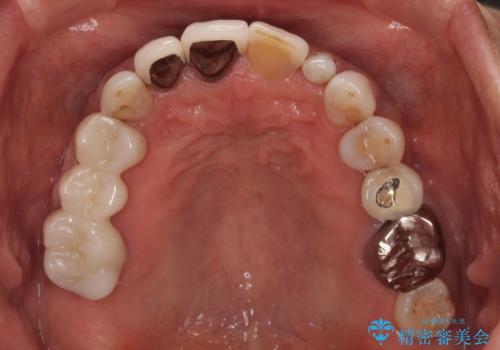 しみる前歯のセラミック治療　周辺も同時に治療して調和の取れた前歯にの治療前