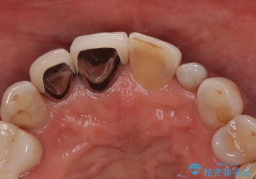 しみる前歯のセラミック治療 周辺も同時に治療して調和の取れた前歯にの治療前