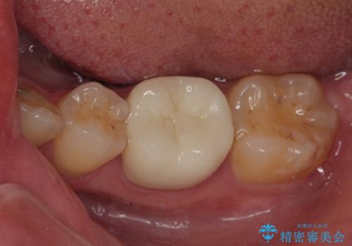 左下が虫歯になっている気がする オールセラミッククラウンの症例 治療後