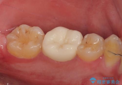 左下が虫歯になっている気がする オールセラミッククラウンの治療後