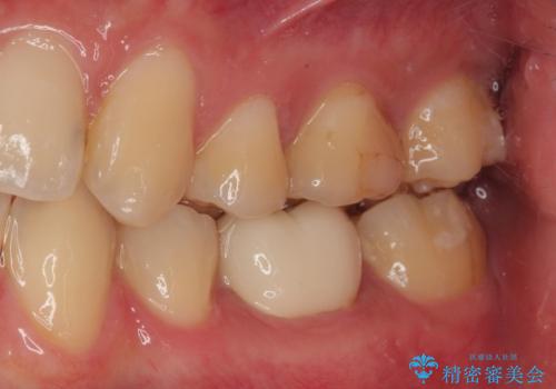 左下が虫歯になっている気がする　オールセラミッククラウンの治療後