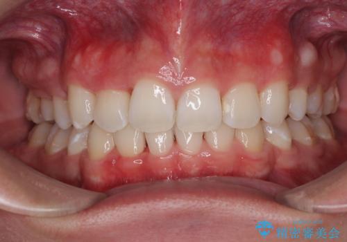 抜歯矯正で叢生と正中のずれを改善|審美装置による矯正症例の症例 治療後