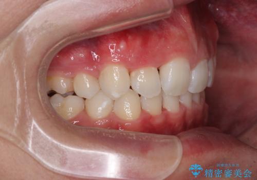 抜歯矯正で叢生と正中のずれを改善|審美装置による矯正症例の治療後