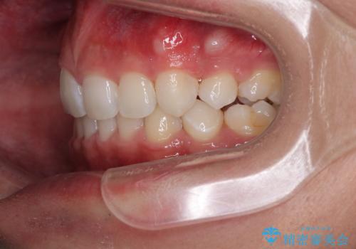 抜歯矯正で叢生と正中のずれを改善|審美装置による矯正症例の治療後