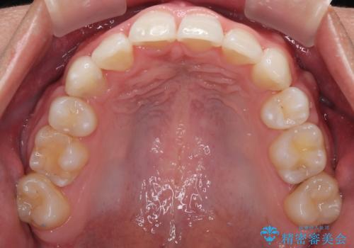 抜歯矯正で叢生と正中のずれを改善|審美装置による矯正症例の治療後