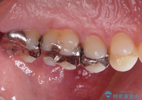 【メタルフリー】銀歯を綺麗な白い歯に