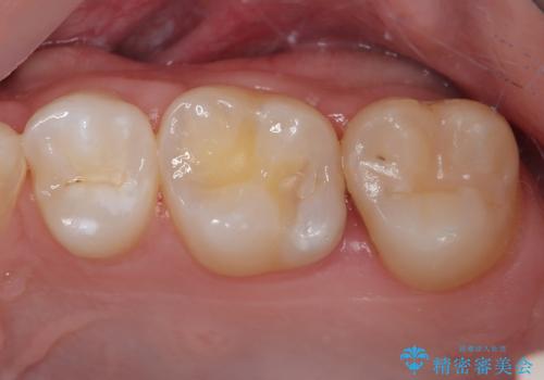 抜歯矯正で叢生と正中のずれを改善|審美装置による矯正症例の治療前