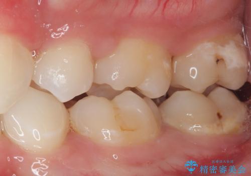 抜歯矯正で叢生と正中のずれを改善|審美装置による矯正症例の治療前