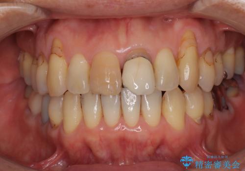 色のバランスの悪い前歯　オールセラミッククラウンで自然な口元にの治療前