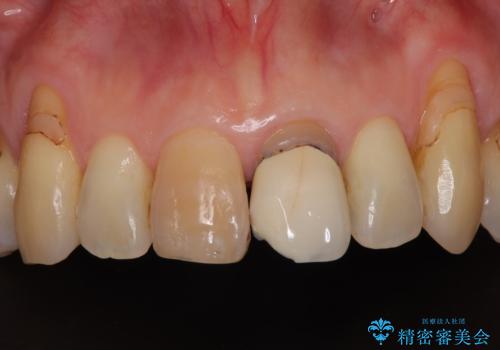 色のバランスの悪い前歯　オールセラミッククラウンで自然な口元に