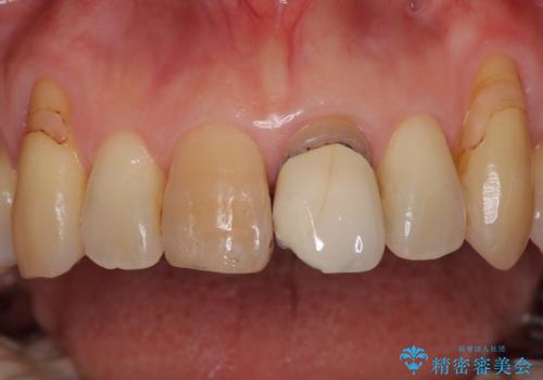 色のバランスの悪い前歯　オールセラミッククラウンで自然な口元にの治療前