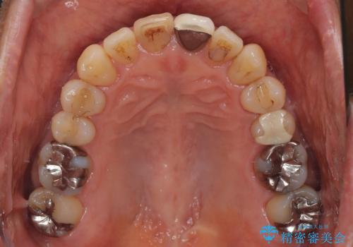 色のバランスの悪い前歯　オールセラミッククラウンで自然な口元にの治療前