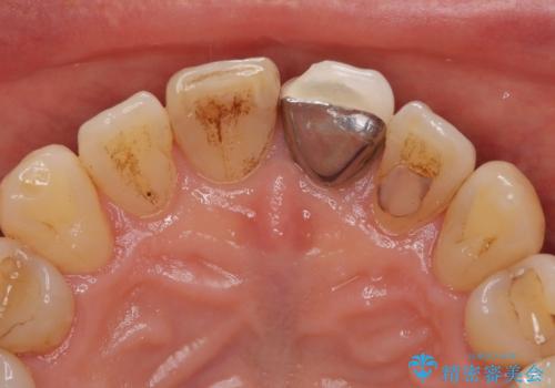 色のバランスの悪い前歯 オールセラミッククラウンで自然な口元にの治療前