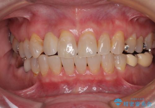 新幹線&飛行機で通院　最小限の通院で前歯のインプラント治療の治療後