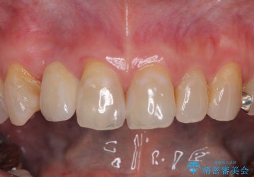 新幹線&飛行機で通院　最小限の通院で前歯のインプラント治療の治療後