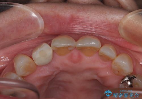 新幹線&飛行機で通院 最小限の通院で前歯のインプラント治療の治療後