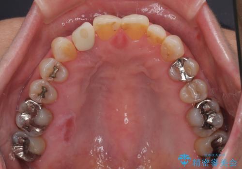 新幹線&飛行機で通院 最小限の通院で前歯のインプラント治療の治療後