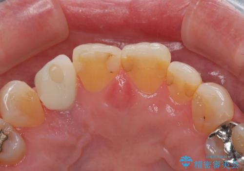 新幹線&飛行機で通院　最小限の通院で前歯のインプラント治療の治療後