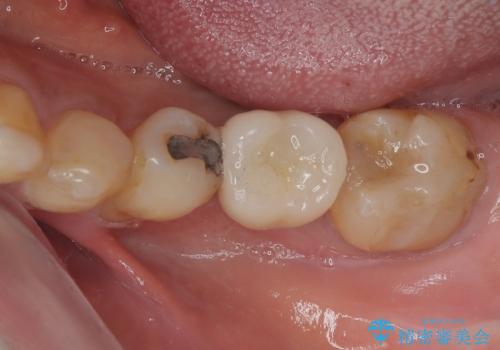 割れてしまった奥歯 1DAYインプラント治療の治療後