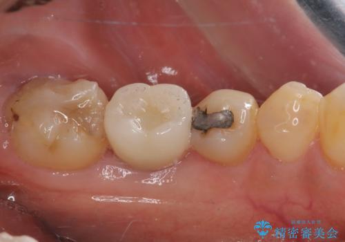 割れてしまった奥歯　1DAYインプラント治療の治療後