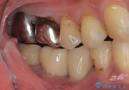 抜歯とむし歯治療を途中で放置 インプラント補綴治療の治療後