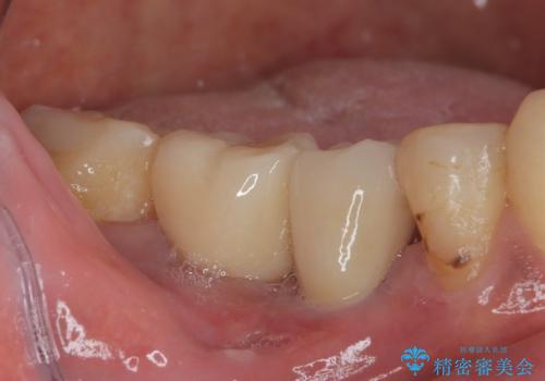 抜歯とむし歯治療を途中で放置 インプラント補綴治療の治療後