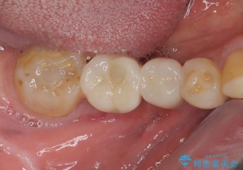 抜歯とむし歯治療を途中で放置　インプラント補綴治療の症例 治療後