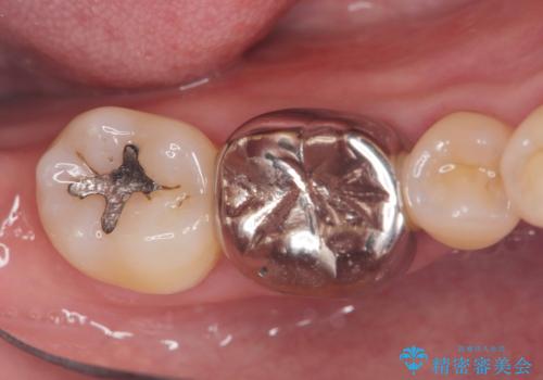 銀歯を白くしたい!|オールセラミッククラウンで審美回復の症例 治療前