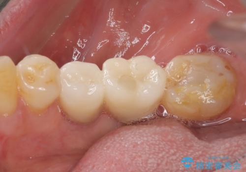 抜歯とむし歯治療を途中で放置 インプラント補綴治療の治療後