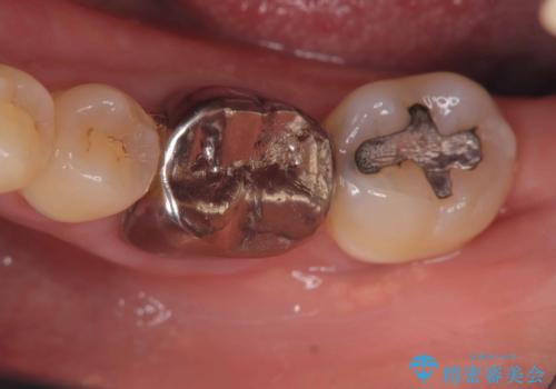 根尖性歯周炎|分岐部病変|パーフォレーション|インプラントで治療の症例 治療前