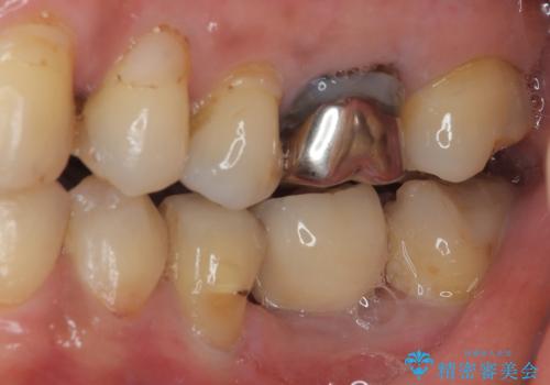割れてしまった奥歯　1DAYインプラント治療の治療後