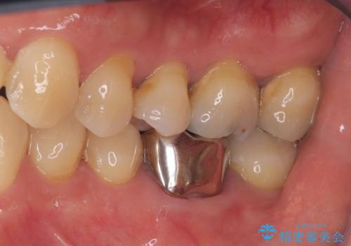 根尖性歯周炎|分岐部病変|パーフォレーション|インプラントで治療の治療前