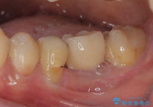 割れてしまった奥歯 1DAYインプラント治療の治療後
